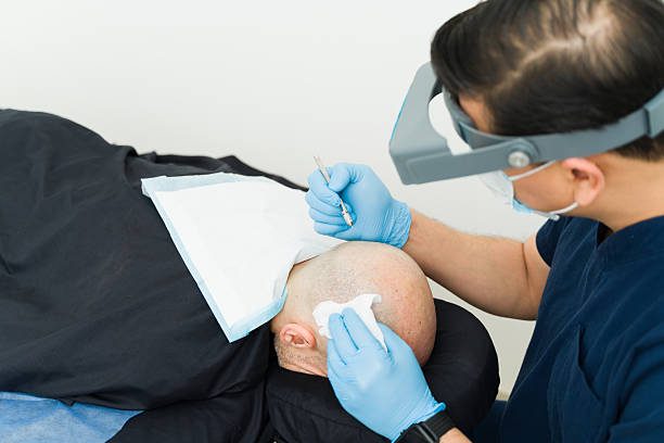 Hair Transplant in Riyadh